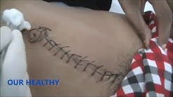 Rawat Luka Post Operasi Appendicitis (Usus Buntu) - Durasi: 6.59. 
