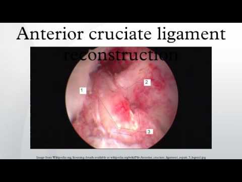 Anterior cruciate ligament reconstruction