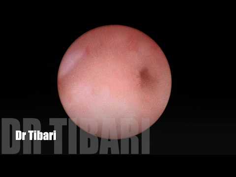 ureterocele gauche et Lithiase  القيلة الحالبية