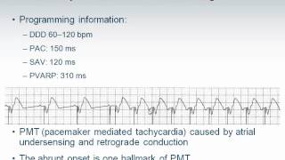 Pacemaker Troubleshooting