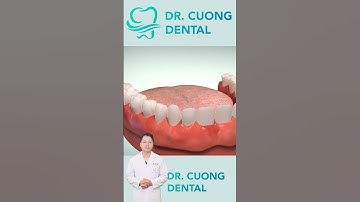 Cấy Răng Implant Sẽ Như Thế Nào? |Dr Cường Official