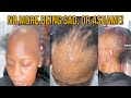Alopeciahair loss no more feeling sad ashame or embarrassed