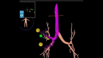 Fiducial Markers Placement   superDimension   Lung Model