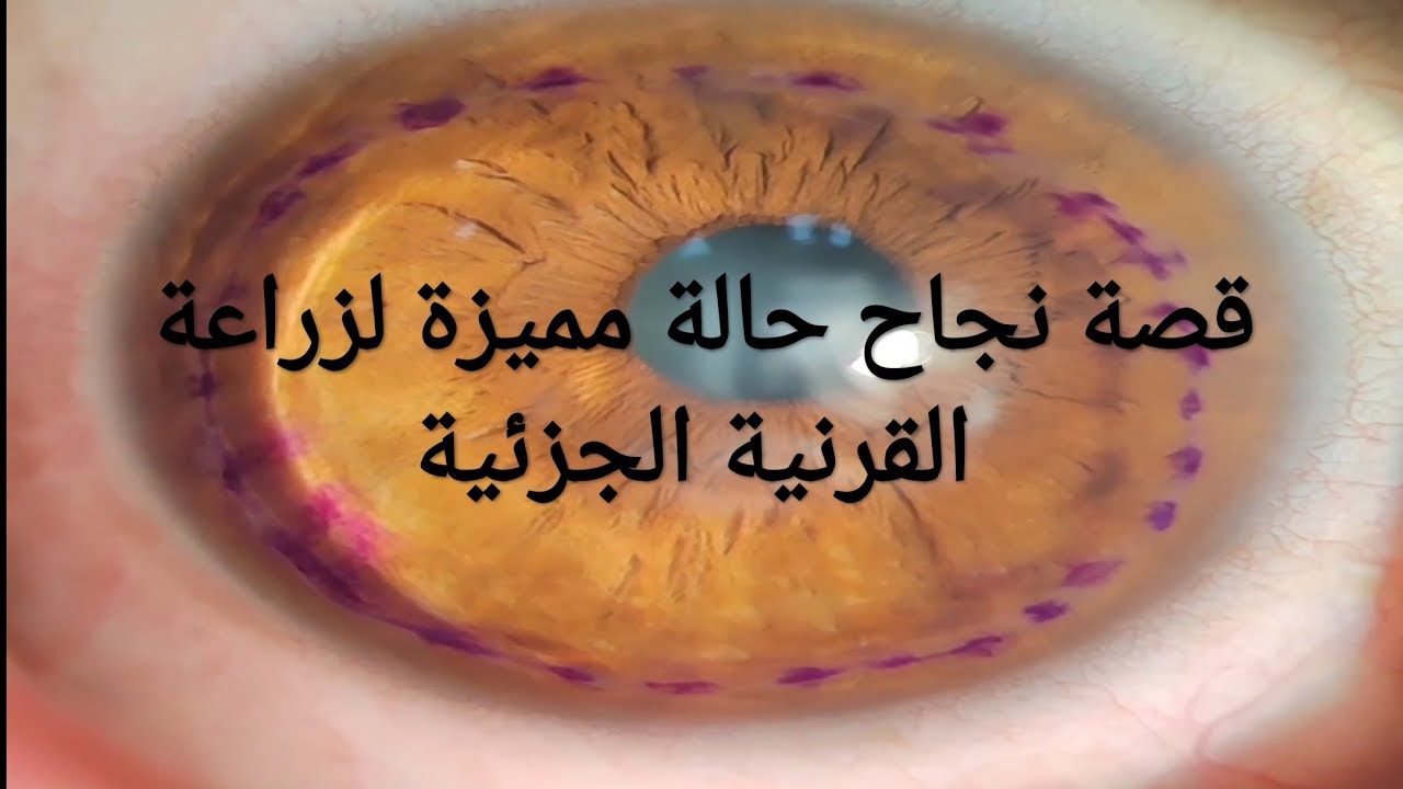 قصة  نجاح حالة مميزة  لزراعة القرنية الجزئية ( الصفائحي)