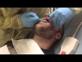 Large Facial Abscess