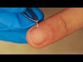 Removing a hangnail painlessly
