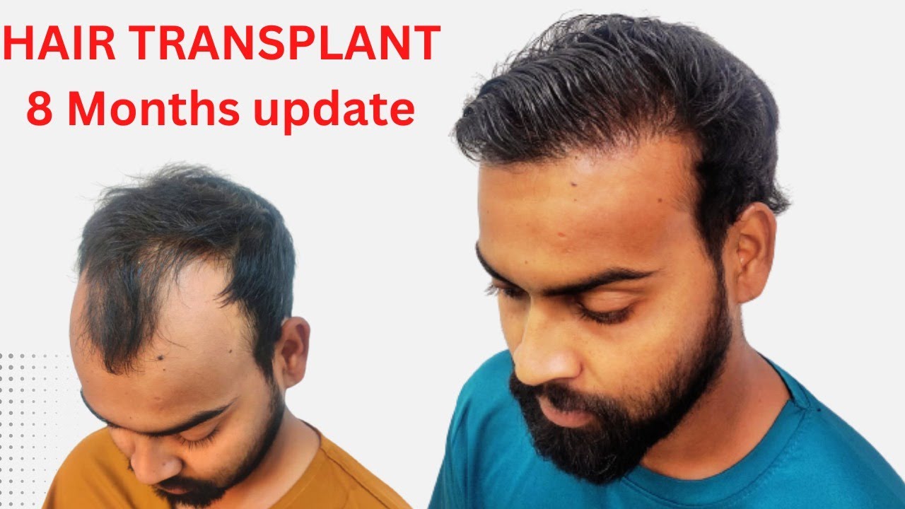Hair transplant in jabalpur Best hair transplant results jabalpur