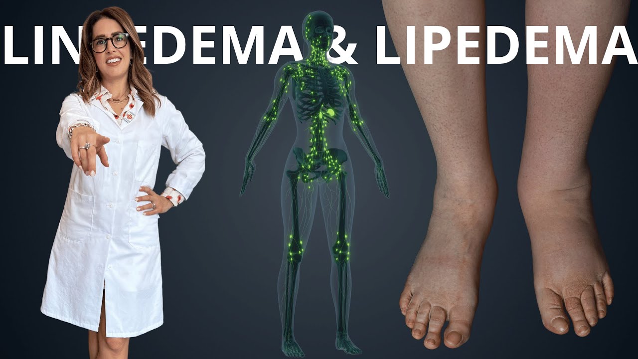 S.2 Ep.23 LINFEDEMA E LIPEDEMA
