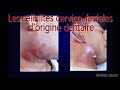 Les cellulites cervicofaciale dorigine dentaire