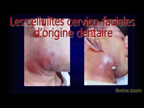 Vidéo: Nécrose Cutanée - Symptômes De Nécrose Cutanée, Nécrose Cutanée Après Chirurgie, Traitement