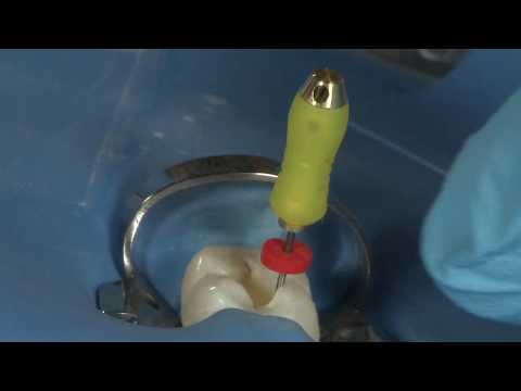 Video: Under endodontisk behandling vannes pulpakanalene med?