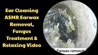 Ear Cleaning ASMR Earwax Removal, Fungus Treatment &amp; Relaxing Video