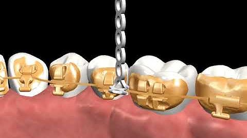 Incognito™ Appliance System Clinical Guide 06: Lasso Elastic (Conventional Lasso)