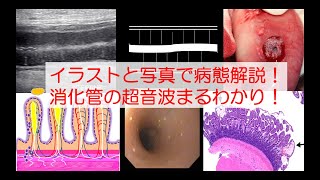 消化器疾患の病態とエコー画像を理解しよう！