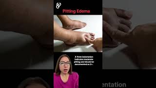 Pitting Edema: Health Assessment SHORT | @LevelUpRN