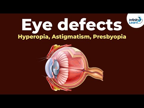 Eye defects - Hyperopia, Astigmatism, Presbyopia | Don&rsquo;t Memorise