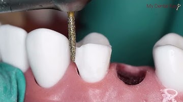 CDCA Exam Prep 3 to 5