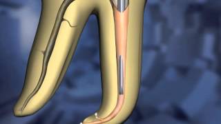 Calamus® - Hybrid Technique | Dentsply Sirona