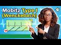 Mobitz Type 1 (Wenckebach) ECG Explained | Second-Degree AV Block Made Easy