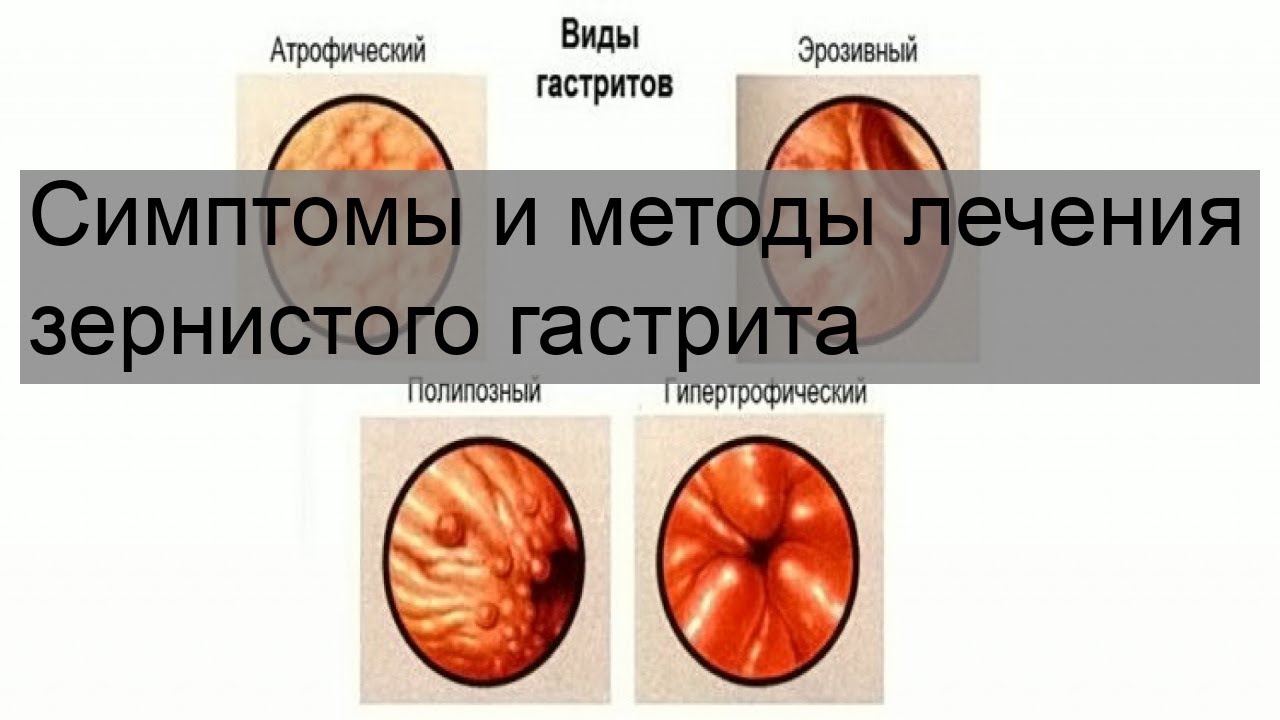 Симптомы и методы лечения зернистого гастрита
