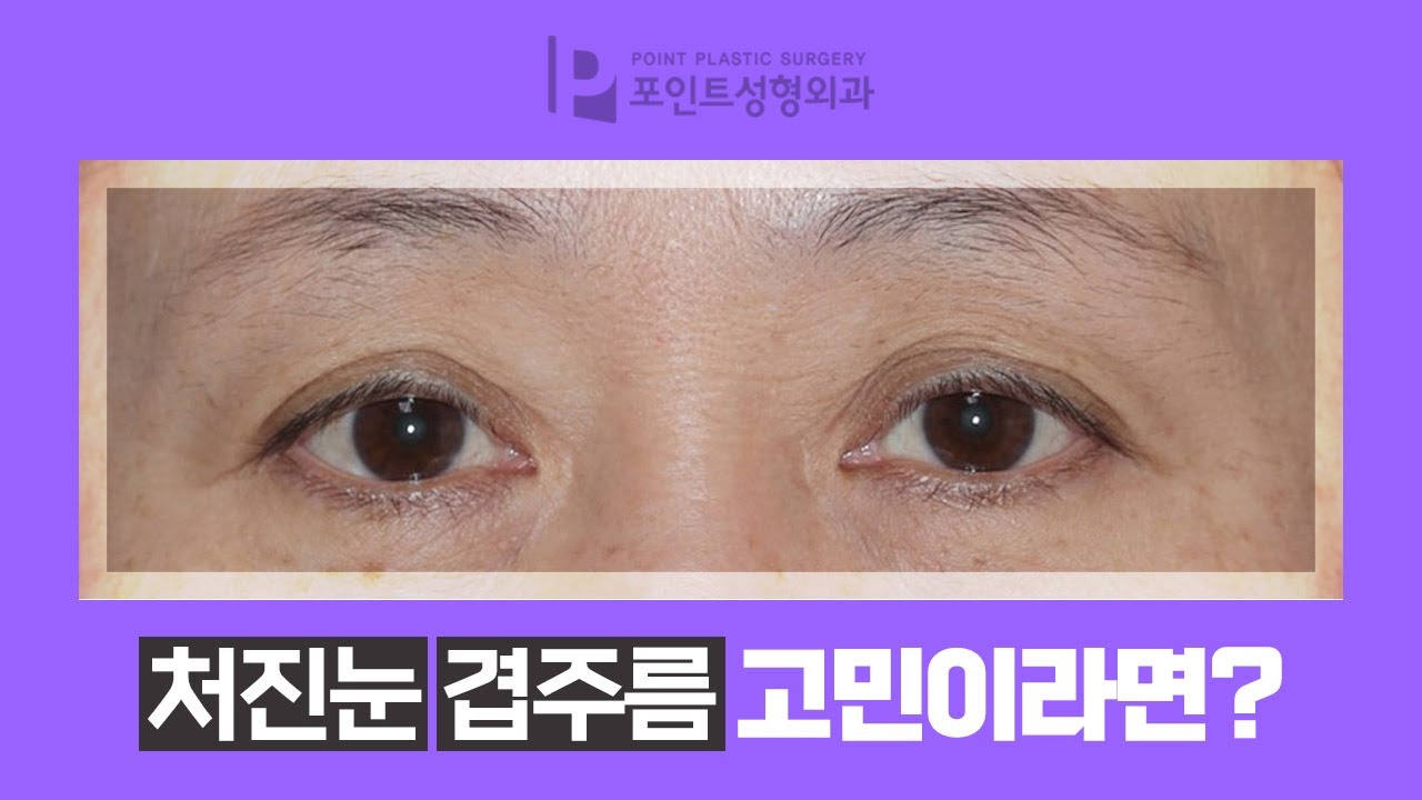 [눈성형/수술전후] 처진눈꺼풀 겹주름쌍꺼풀 눈썹하거상 쌍꺼풀수술