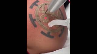 Removing Tattoo