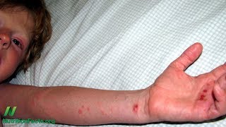 Prevence dětských alergií