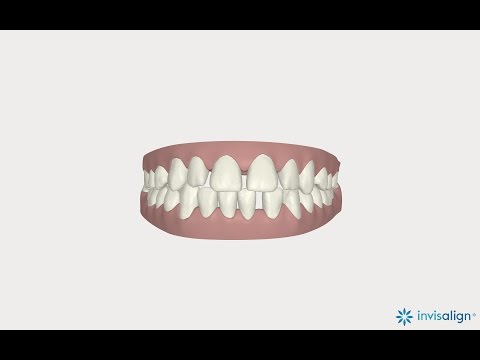 סגירת רווח בין שיניים? אינויזליין - יישור שיניים שקוף