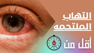 التهاب الملتحمة 👀 في أقل من 60 ثانية