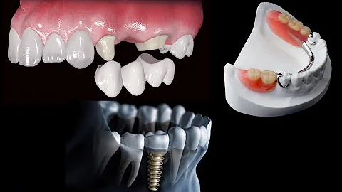 O que substitui um implante dentário?