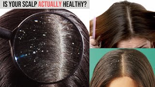 How to Treat Dandruff, Dermatitis, or Scalp Psoriasis | Causes, Symptoms, and Treatments.
