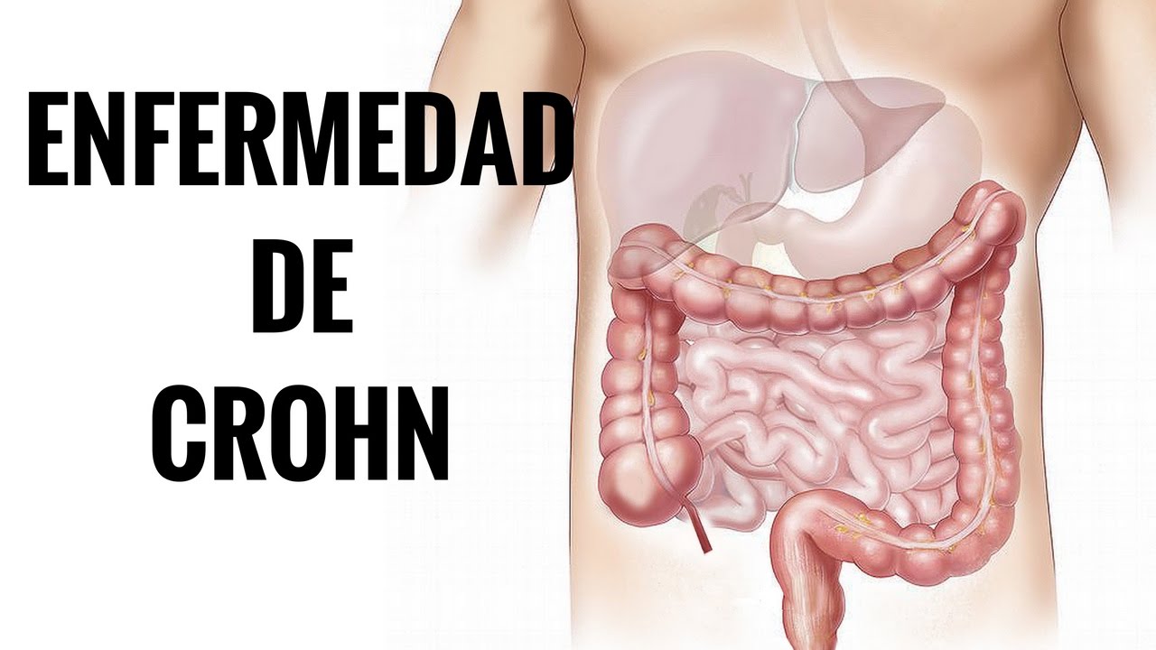 Tratamiento nutricional en enfermedad de crohn pdf