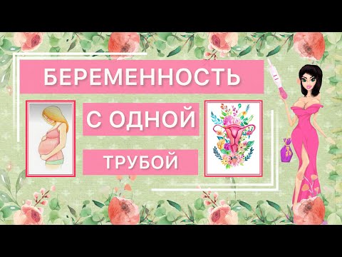 🔴✅БЕРЕМЕННОСТЬ С ОДНОЙ ТРУБОЙ. ТРУБНЫЙ ФАКТОР