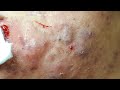 Poor younger with many"Cysts" at hien van spa|348|Trọng Đại