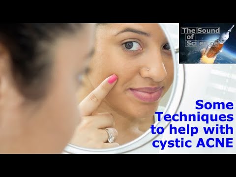 Acne Treatment - tips and techniques to help with cystic ACNE