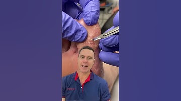 Say Goodbye to Seed Corns: Easy Foot Care Tips with Docpods #FootHealth #SeedCornRemoval