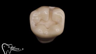 class 1 with buccal extension شرح عربي مفصل
