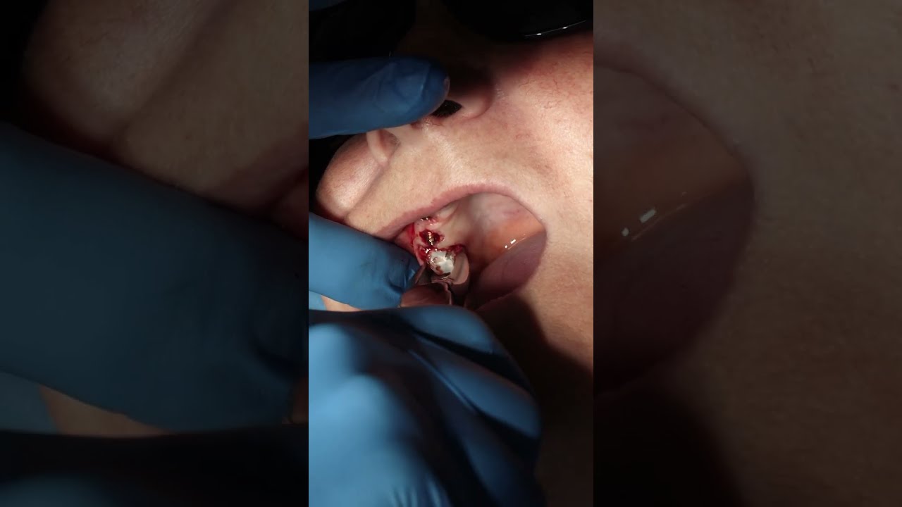 Beautiful Tooth Extraction Painless Dentistry Shorts Health Beauty