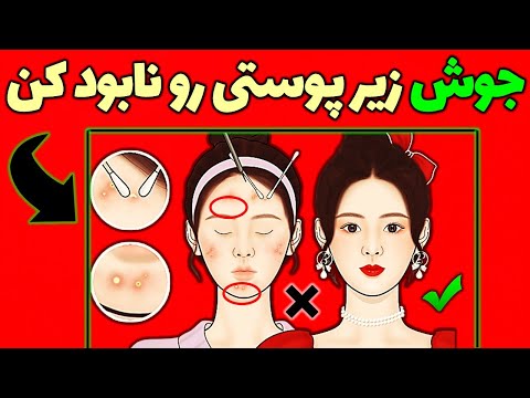 تصویری: چه زمانی نگران جوش صورت باشیم؟