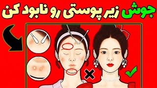 درمان جوش های زیر پوستی صورت|رفع جوش های زیر پوستی|درمان سریع جوش صورت