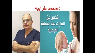 علاج الغازات بعد الولادة القيصرية و الطبيعية. #دكتور_محمد_طرابيه