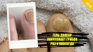 ❕ НОГТЕВОЙ ГРИБОК ЛЕЧЕНИЕ НАРОДНЫМИ СРЕДСТВАМИ БЫСТРО ✔ ЛЕЧЕНИЕ ГРИБКА НОГТЕЙ ЦЕНА 👍