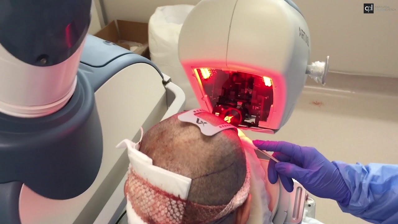 El robot Artas 9x en funcionamiento para implante capilar - YouTube