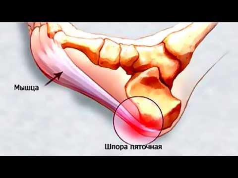 Бейне: Пятки ауруы мен плантарлы фаститтен қалай аулақ болуға болады (суреттермен)