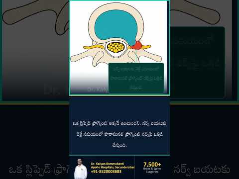 మీ స్పైన్‌లో ఇప్పటికే ఉన్న సైడ్ విండో — బెస్ట్ ఎండోస్కోపిక్ స్పైన్ సర్జన్, హైదరాబాద్