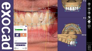 exocad Quick Guide: Get the most out of your Smile Creator Module! screenshot 3