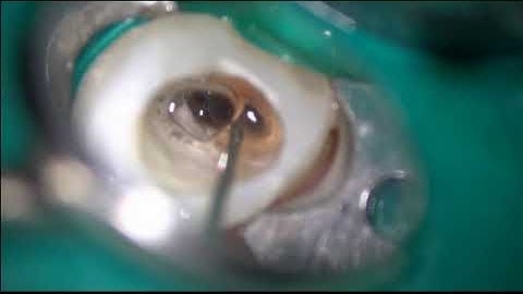 Removal of a non-visible broken file/見えない破折器具の除去