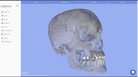 Short video showing the CEPHX system