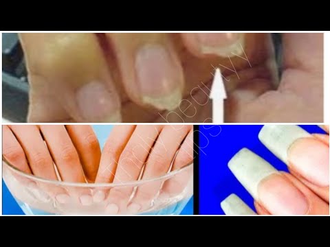 Vidéo: Ongles Cassants: Causes, Traitement Et Prévention