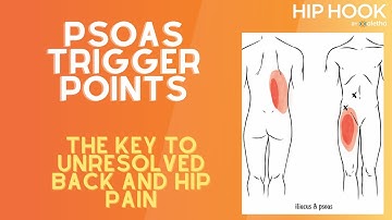 Psoas trigger points